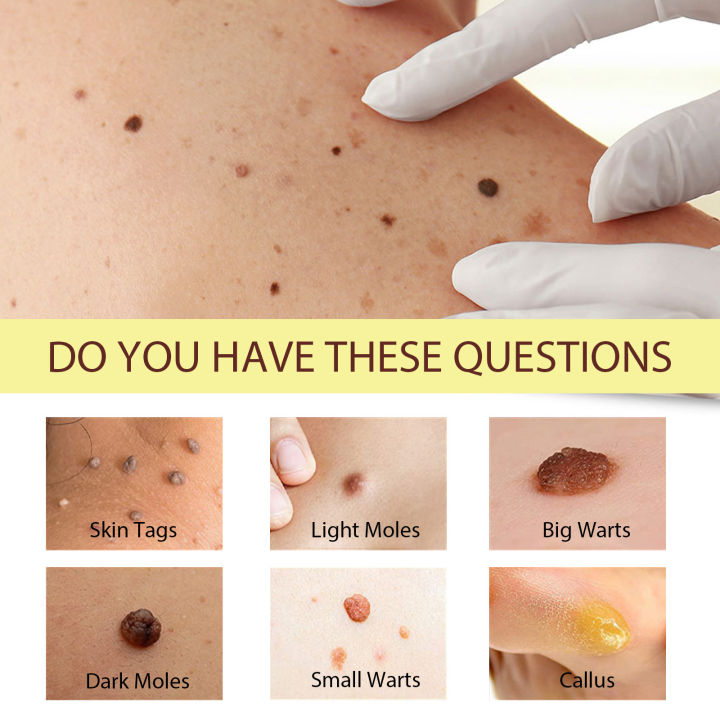 Glovure%20Mole%20Removal%20Cream%20-%20Image%204