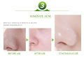 Aichun Beauty Face Acne Cleaning Cream Skin Care Remove Repair Comedone Acne Pimple Remover Cream Anti Acne Treatment 30ml AC225-1. 