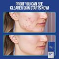 Wiki Special Face Serum – Anti Acne, Oil Control & Skin Brightening | Pore Tightening & Glowing Skin | Best Serum for All Skin Types – 30ml. 