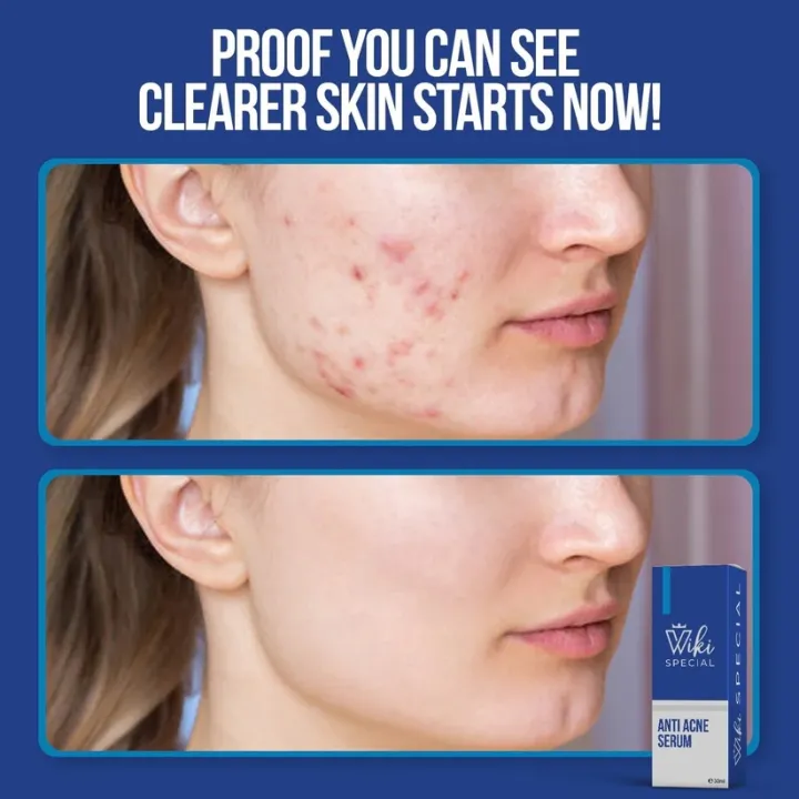 Wiki%20Special%20Face%20Serum%20%E2%80%93%20Anti%20Acne,%20Oil%20Control%20&%20Skin%20Brightening%20%7C%20Pore%20Tightening%20&%20Glowing%20Skin%20%7C%20Best%20Serum%20for%20All%20Skin%20Types%20%E2%80%93%2030ml%20-%20Image%204