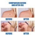 Warts Removal Pen Eliminate Wart Pen Wart Liquid Hand Foot Warts Remove Filiform Warts Flat Warts Condyloma Acuminatum. 
