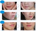 New ACNE & PIMPLES REMOVAL CREAM, Acne Scar Mark Remover Removal Oil Control Shrink Pores Treatments Cream. 