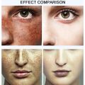 Yoxier Face Cream Dark Spot Corrector Anti-Aging Whitening Moisturizing Remove Sunburn Dark Spots and Acne Pigmentation 30g. 