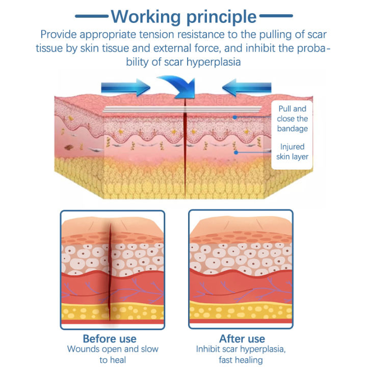 %E3%80%90HOT%E3%80%91%20Wound%20Skin%20Closure%20Strips%20Postpartum%20Wound%20Repair%20Cosmetic%20Surgery%20Steri%20Strip%20Adhesive%20Medical%20Suture%20Free%20Surgical%20Tape%20-%20Image%206