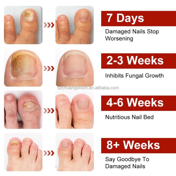 1%20SOLUTION%20SHOP%20Nail%20Fungal%20Treatment%20Patch%20%7C%20Anti%20Fungus%20Toe%20Nail%20Repair%20Strips%20%7C%20Overnight%20Hydrogel%20Patch%20for%20Yellow%20Nails,%20Cracked%20&%20Brittle%20Nail%20Care%20%7C%20Fast%20Nail%20Restoration%20%7C%2021%20Patches%20%7C%20Anti%20Infection%20Nail%20Protector%20for%20Healthy%20Shiny%20Toenails%20-%20Image%209
