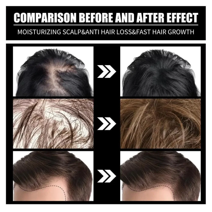 FORT%20%20Minoxidil%20Hair%20Growth%20Spray%20-%20Hair%20Tonic%20for%20Hair%20Care%20and%20Hair%20Growth%20-%20Premium%20Hair%20Care%20ProductWomen%20and%20Men%20all%20Hair%20Types%20-%20Image%202
