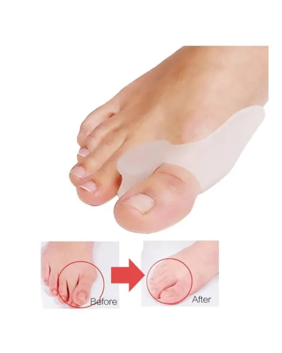 1%20Pair%20Silicone%20Gel%20Bunion%20Protector%20Toe%20Straightener%20Separator%20Alignment%20Pain%20Relief%20Thumb%20Corrector%20-%20Image%206