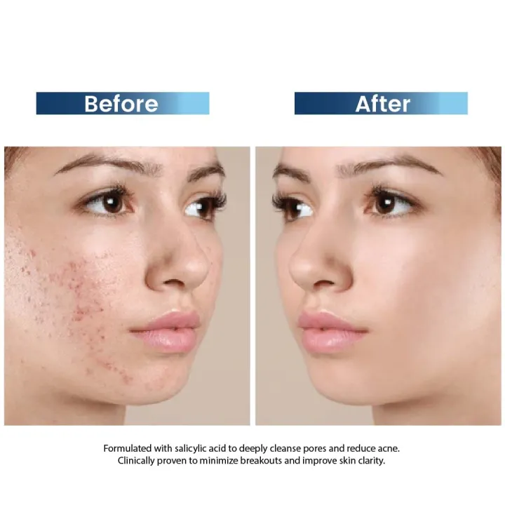 Rederm%20Clariderm%20Anti-Acne%20Serum%20-%20Image%205