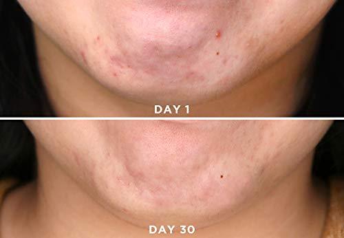 Niacinamide%20(Vitamin%20B3)%20Powder%20%E2%80%93%20Skin%20Brightening%20&%20Anti-Acne%20Active%20-%20Image%205