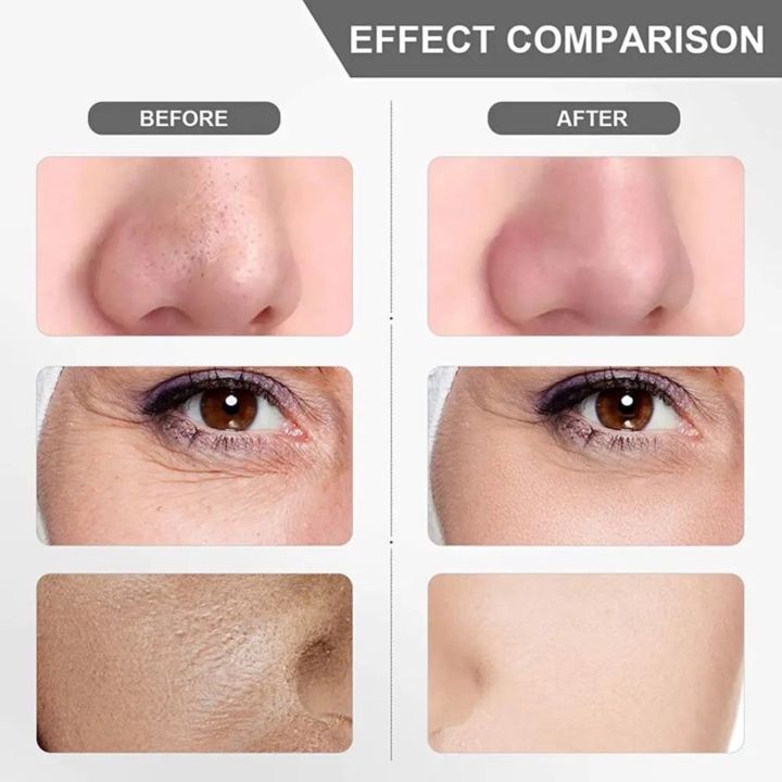 Black%20Head%20Remover%20Machine%20-%20Deep%20Face%20Cleanser%20&%20Pores%20Cleaner%20-%20Blackhead%20Removal%20Machine%20-%20Pimple%20Remover%20-%20Blackhead%20Remover%20-%20Face%20Cleaner%20Machine%20-%20Skin%20Scrubber%20for%20Whiteheads,%20Acne,%20and%20Wrinkles%20-%20Ultrasonic%20Face%20Cleaning%20&%20Lifting%20Device%20-%20Image%208