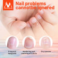 MeiYanQiong Herbal Nail Treatment Onychomycosis Paronychia Anti Fungal Nail Infection Good Result Chinese Herbal Toe Nail Fungus Treatment. 