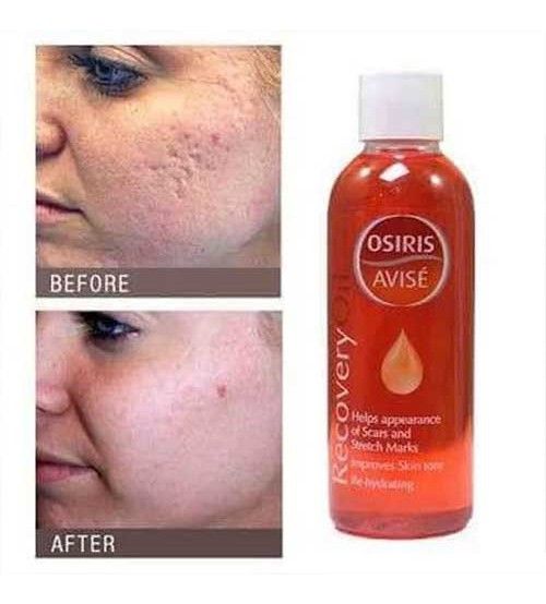 Osiris Avise Recovery Oil Helps Appearance Of Scar & Stretch Marks 100ml in Pakistan