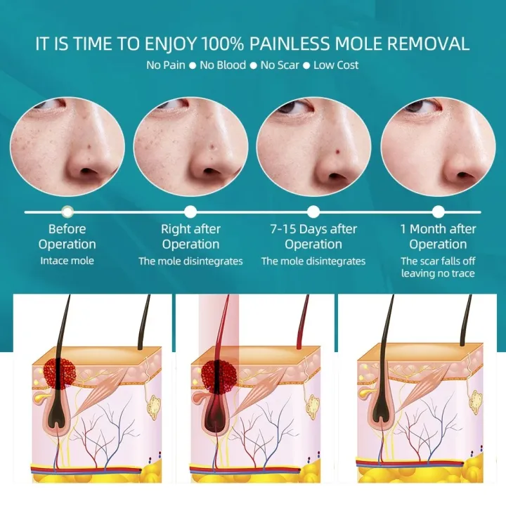 PIXIE%20Face%20Mole%20Removal%20Pen%20Spots%20Tattoo%20Freckle%20Removal%20Pen%20LED%20Lighting%20Sweep%20Spot%20Mole%20Removing%20Dark%20Spot%20Remover%20Skin%20Care%209%20Adjustable%20Modes%20Laser%20Mole%20Pen%20-%20Image%207