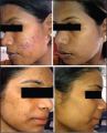 SALICYLIC  peel 15% beta hydroxy acid BHA   for acne, openpores , oilyskin , glow , exfoliation , peeling solution ,. 