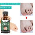 Fast Nail Fungal Treatments Nail Repair Essences Serum Care Treatments Foot Nail Fungus Removal Gel Paronychia Onychomycosis. 