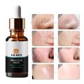 Anti-Acne Serum: (For oil control and acne removal 30ml. 