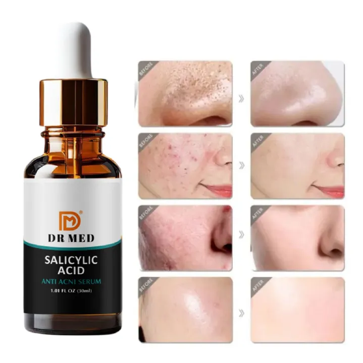 Anti-Acne%20Serum:%20(For%20oil%20control%20and%20acne%20removal%2030ml%20-%20Image%205