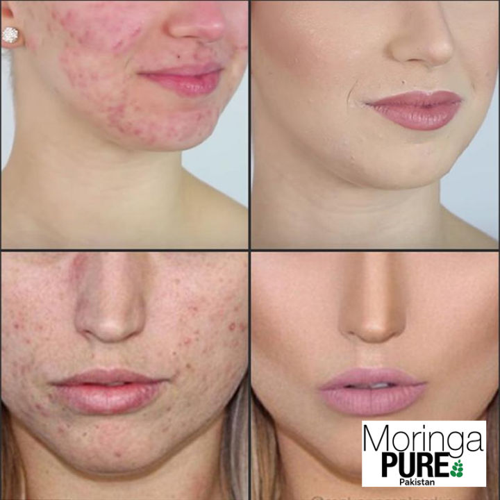 Tea%20Tree%20Oil%20FirstSun%20Pakistan:%20Chinese%20Brand%20for%20Food%20&%20Acne%20-%20Image%205