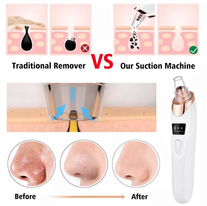 Derma%20Suction%20%7C%205%20in%201%20Multifunction%20Blackhead%20Removal%20Rechargeable%20Machine%20%7C%20White%20Head%20Vacuum%20Suction%20Face%20Pore%20Cleaner%20Nose%20Sucking%20Extractor%20%7C%20Blackheads%20Removal%20Device%20Derma%20Suction%20Chargeable%20-%20Image%204
