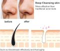 Rechargeable Blackhead Removal Machine 4 in 1 - Powerful Acne Pimple Pore Cleaner | Vacuum Suction Tool. 