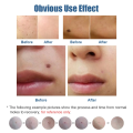 Profesional Laser Plasma Pen Skin Care Beauty Tool Black Dot Pore Skin Tag Blackhead Remover Warts Tattoo Removal Face Skin Care. 