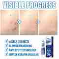 20g Instant Blemish Removal Gel Wart Removal Body Warts Treatment Cream Foot Care Cream Skin Tag Remover Wart Cream. 