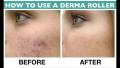 Derma Roller For Body And Face And Eye Titanium Micro Needles Skin Dermaroller. 