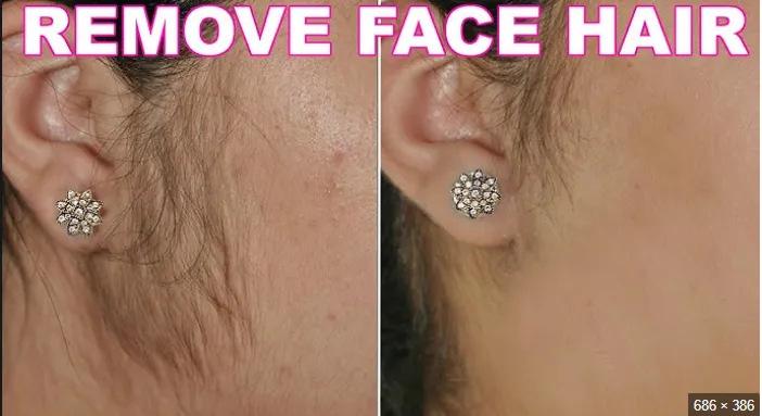 Sydonic%20Permanent%20Facial%20hair%20Removal%20Treatment%20Cream%20%7C%20Permanent%20Hair%20Removal%20Treatment%20Cream%20%7C%20Painless%20Hair%20Remover%20Cream%20-%20Image%203