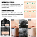 Nose Blackhead Remover Mask Deep Cleansing Skin Care Shrink Pore Acne Treatment Mask Nose Black dots Pore Clean. 