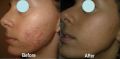 SALICYLIC  peel 15% beta hydroxy acid BHA   for acne, openpores , oilyskin , glow , exfoliation , peeling solution ,. 