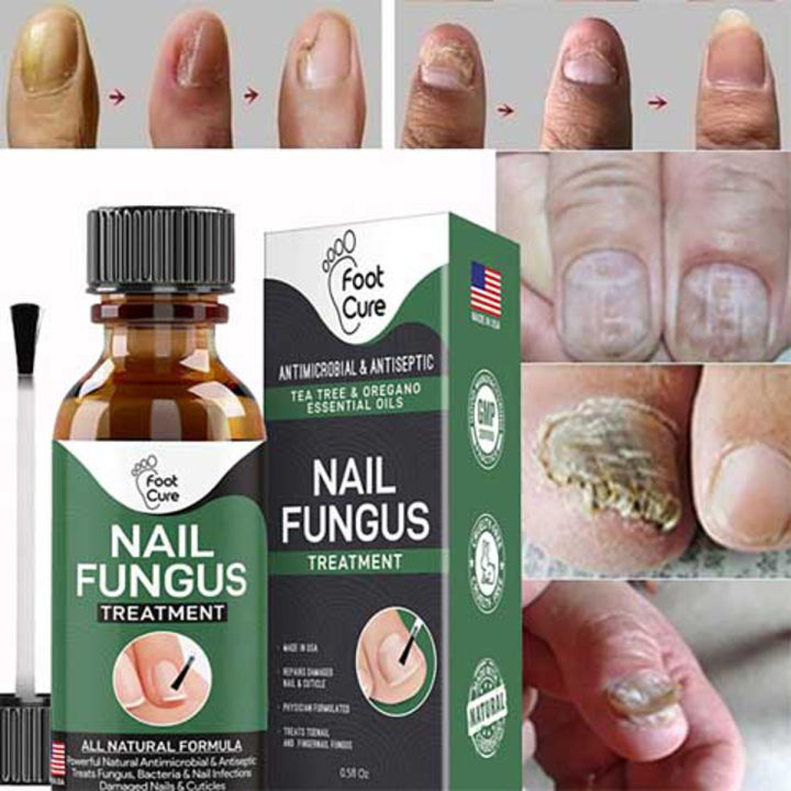 Nail Fungus Nail Fungus Treatment Nail Repair Nail Infection Finger Nail Treatment Fungus Remover Fungus Treatment 10ml Zumer Trade Daraz.pk