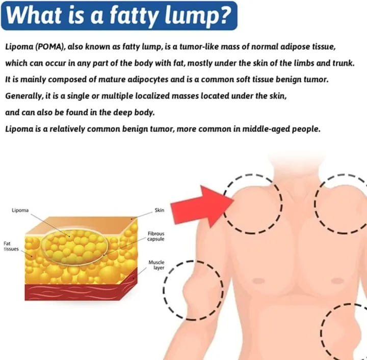 Lipoma%20Removal%20Cream%20South%20Moon%20%7C%20Lipoma%20Removal%20%7C%20Lipoma%20Remover%20-%20Image%204
