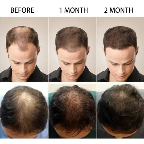 Hair%20Growth%20Serum%20%E2%80%93%20Anti%20Hair%20Fall%20%E2%80%A2%20Faster%20Hair%20Regrowth%20%E2%80%A2%20Strengthens%20Roots%20%E2%80%A2%20Thick,%20Healthy%20&%20Volumized%20Hair%20%E2%80%93%20Herbal%20Extract%20Formula%20%E2%80%93%2030ml%20-%20Image%208