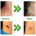 Medical Skin Tag Kill Skin Mole Wart Remover Micro Band Skin Tag Removal Kit With Cleansing Swabs Adult Mole Wart Face Care. 