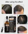 Pei Mei Hair Growth Essential Oil – Anti Hair Fall, Fast Hair Regrowth, Strengthening & Nourishing Scalp Treatment Serum for Men & Women. 