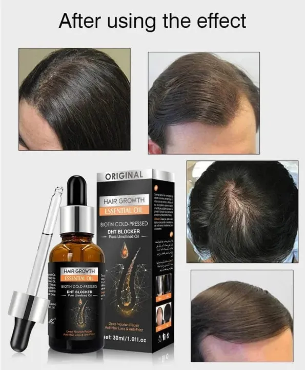 Pei%20Mei%20Hair%20Growth%20Essential%20Oil%20%E2%80%93%20Anti%20Hair%20Fall,%20Fast%20Hair%20Regrowth,%20Strengthening%20&%20Nourishing%20Scalp%20Treatment%20Serum%20for%20Men%20&%20Women%20-%20Image%207