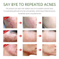 FORT Salicylic Acid Serum – Anti-Acne Face Serum & Dark Spot Correcting Serum for Glowing Skin | Acne Skin Care Products 30ml. 