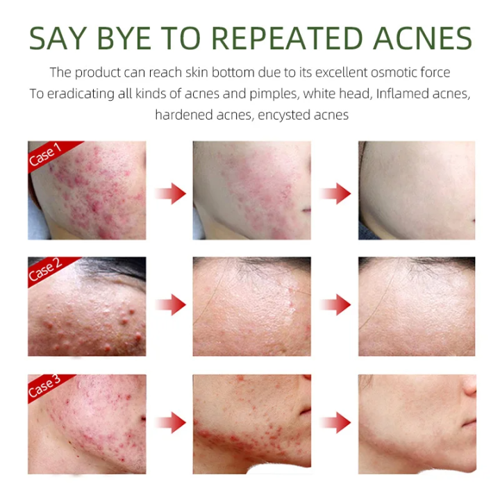 FORT%20Salicylic%20Acid%20Serum%20%E2%80%93%20Anti-Acne%20Face%20Serum%20&%20Dark%20Spot%20Correcting%20Serum%20for%20Glowing%20Skin%20%7C%20Acne%20Skin%20Care%20Products%2030ml%20-%20Image%203