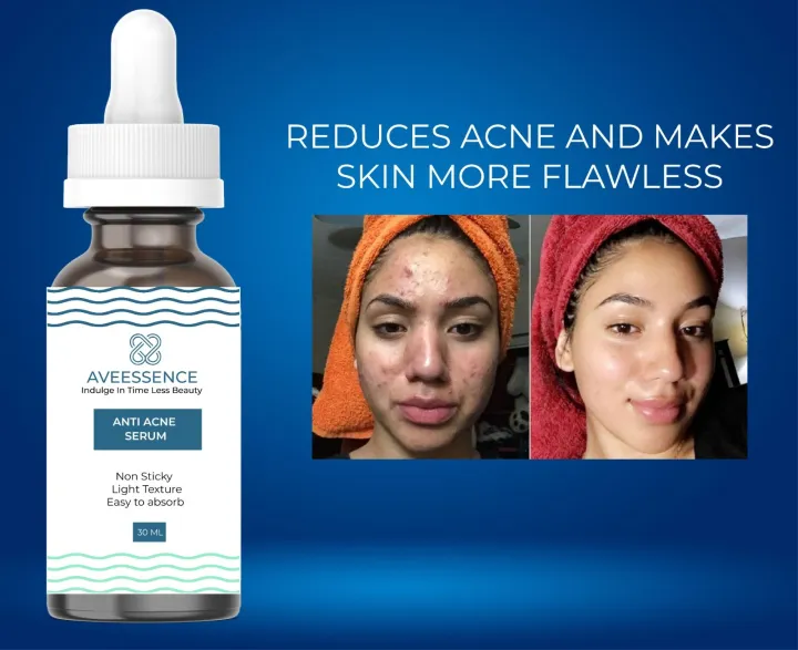 AVEESSENCE%20Anti%20acne%20serum%20Best%20anti%20acne%20serum%20for%20acne-prone%20skin%20Acne%20treatment%20serum%20Serum%20for%20acne%20scars%20Best%20serum%20for%20acne%20and%20blemishes%20Anti%20acne%20serum%20for%20clear%20skin%20Acne-fighting%20serum%20for%20oily%20skin%20Acne%20serum%20with%20salicylic%20acid%20Natural%20-%20Image%203