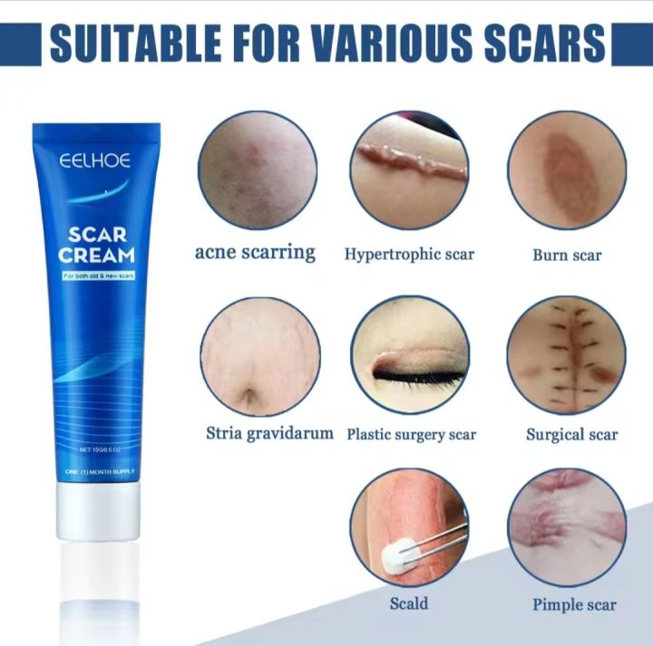 Scar Removal Cream Burn  Scar Treatment