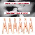 1 Box/12Pcs Copper Skin Tag Remover Clips Wart Tag Extractor Copper Tag Out Skin Tag Removal Tool. 