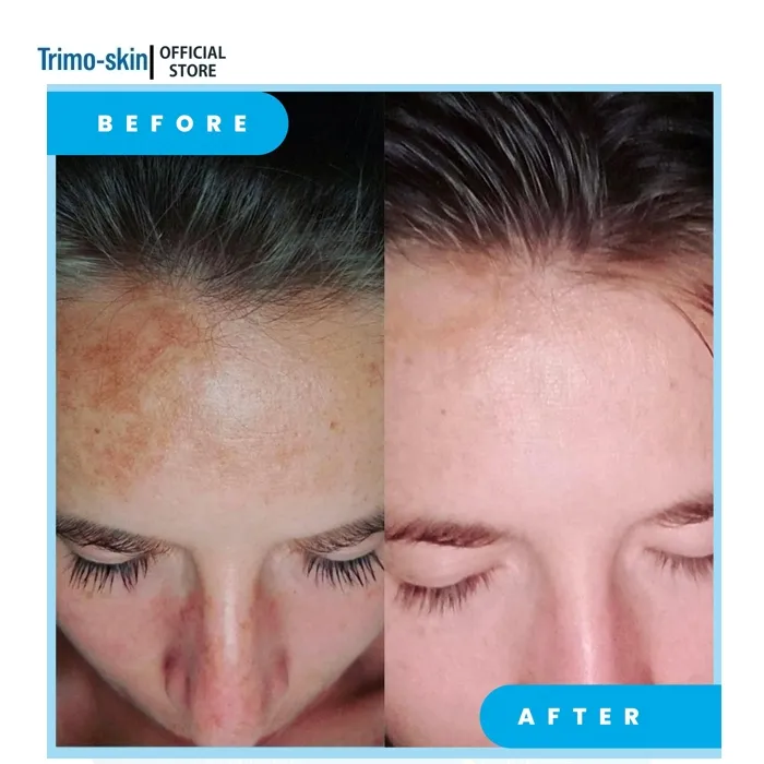 Pack%20of%205%20-%20Clobewate%20Kojic%20Acid%20Cream%20for%20All%20Skin%20Types%20-%20Moisturizing%20Skincare%20Solution%20with%20the%20Power%20of%20Kojic%20Acid%20-%20Exclusive%20Combo%20Offer%20-%20Image%203