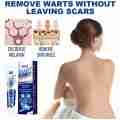 20g Instant Blemish Removal Gel Wart Removal Body Warts Treatment Cream Foot Care Cream Skin Tag Remover Wart Cream. 