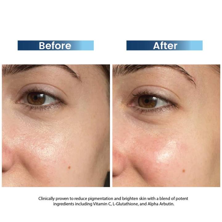 Rederm%20Wynn%20Brightening%20&%20Depigmentation%20Cream%20-%20Image%205