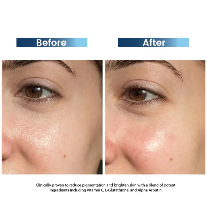 Rederm%20Wynn%20Brightening%20&%20Depigmentation%20Cream%20-%20Image%205