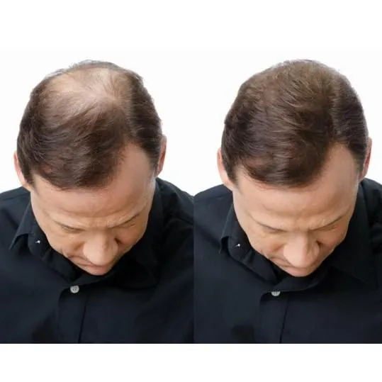 King%20Hair%20Building%20Fibers%20Dark%20Brown%20Refill%20100%20Gram%20Refill%20-%20Refill%20Your%20Existing%20King%20Fiber%20Bottle%20-%20King%20Hair%20Filler%20Fibers%20-%20Toppik%20alternative-%20Concealer%20by%20Caboki%20Hair%20Fibers,%20King%20Refill%20Pack%20-%20Image%202