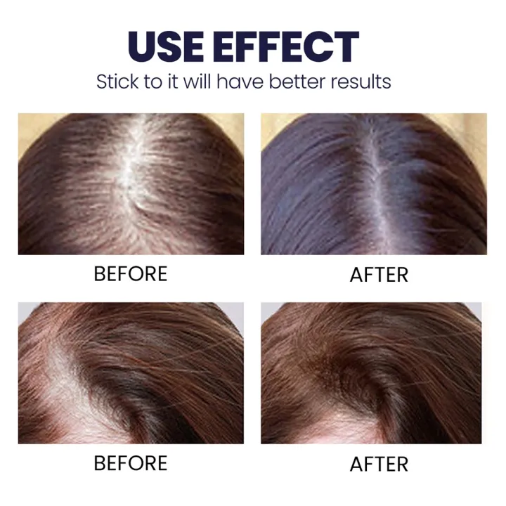 Arfa Cosmetics Minoxidil 5% Hair Growth Minoxidil Spray Hair Tonic For Hair Care Hair Loss and Hair Growth Premium Hair Care Product Women and Men All Hair Types 120Ml