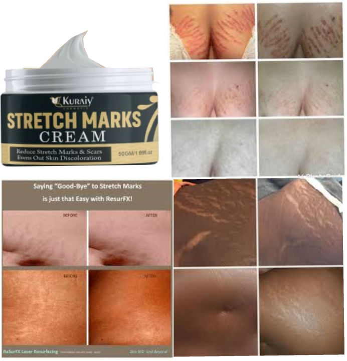Derma Queen Best Stretch Marks Removal Cream 30ml, Pregnancy Stretch Marks Removal Cream, Remove Stretch Marks Cream, Stretch Mark Removal Cream for Body