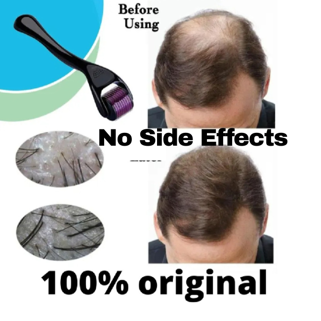 Derma Roller Titanium needles 0.5 Mm Hair & Skin System - Titanium needles - Best quality derma roller - guaranteed