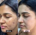 Kojic Acid Cream for Dark Spots & Hyperpigmentation Skin Brightening & Acne Scar Remova Vitamin B5. 